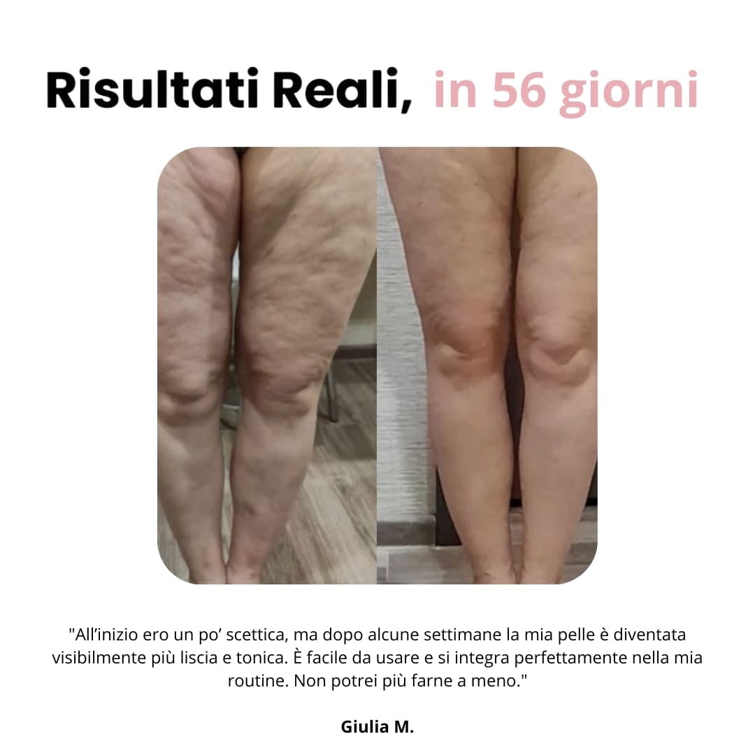 Velina™ - Masseur anti-cellulite