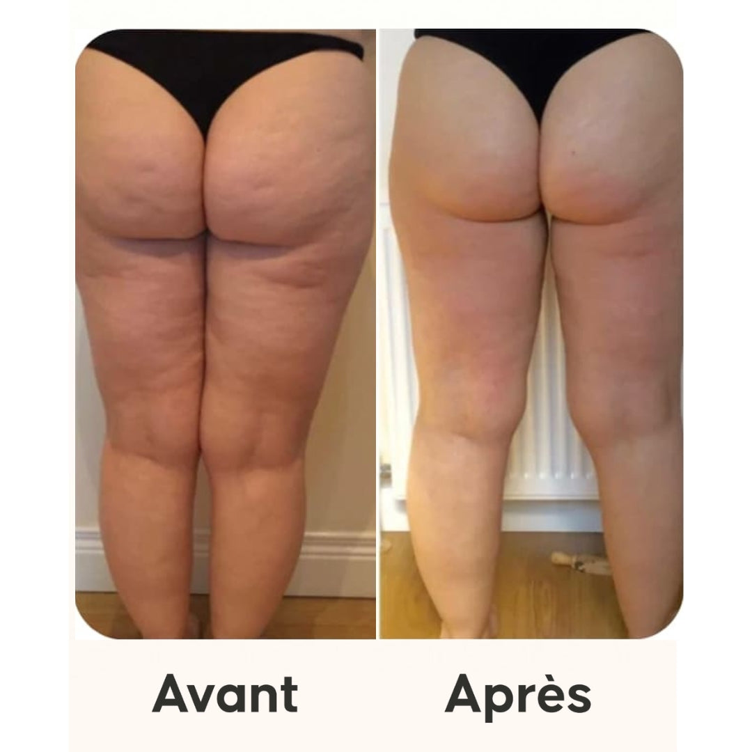 Velina™ - Masseur anti-cellulite